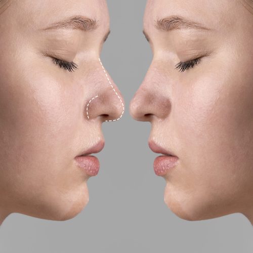 rhinoplasty-surgery-concept-with-woman-model rhinoplasty-surgery-concept-with-woman-model