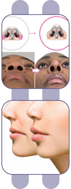 rinoplastia-ondas-6-06