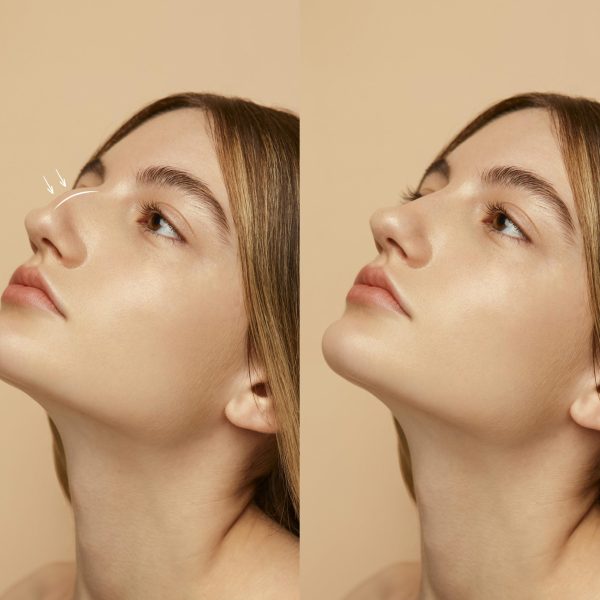 woman-getting-ready-nose-job-surgery